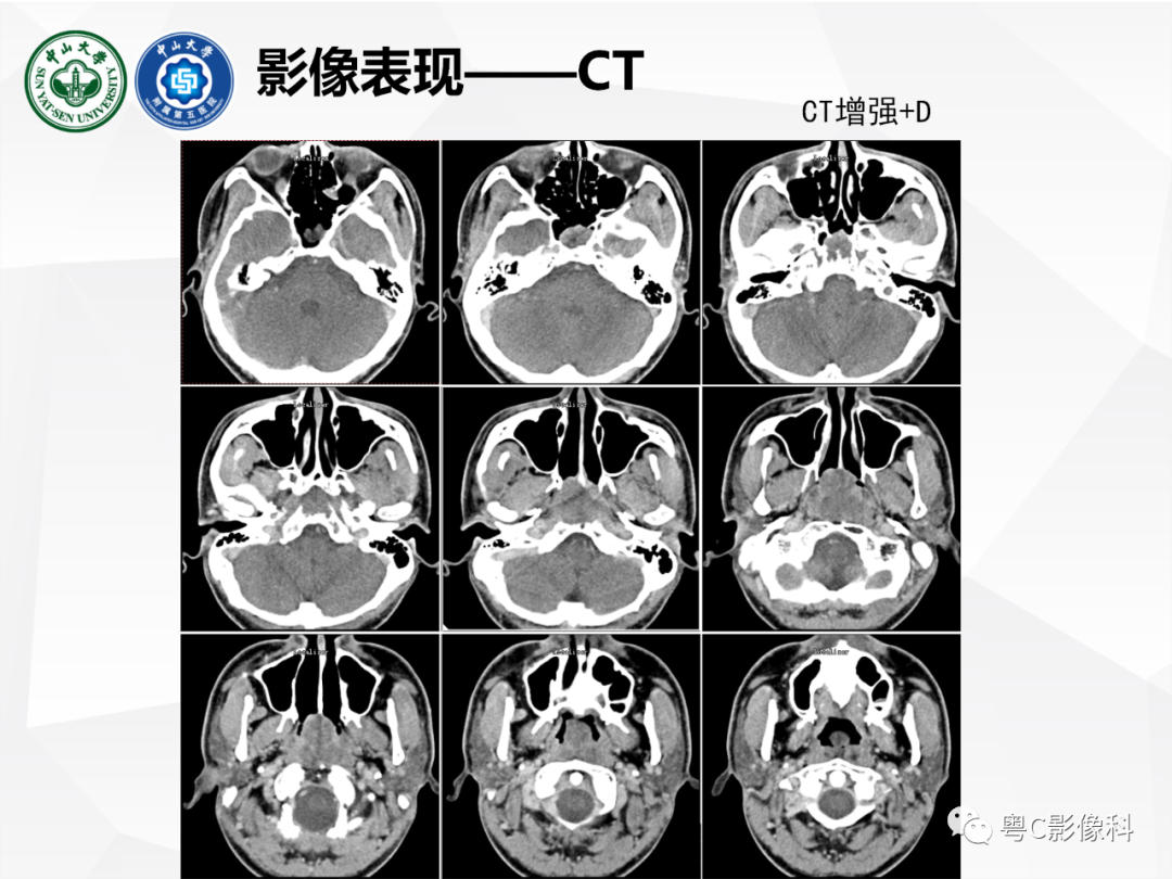 影像PPT - 【病例】颅底脊索瘤1例CT及MR影像表现及鉴别诊断-7