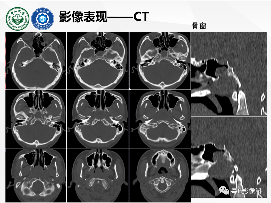 影像PPT - 【病例】颅底脊索瘤1例CT及MR影像表现及鉴别诊断-8