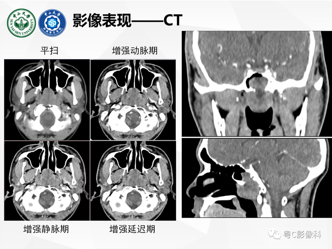 影像PPT - 【病例】颅底脊索瘤1例CT及MR影像表现及鉴别诊断-9