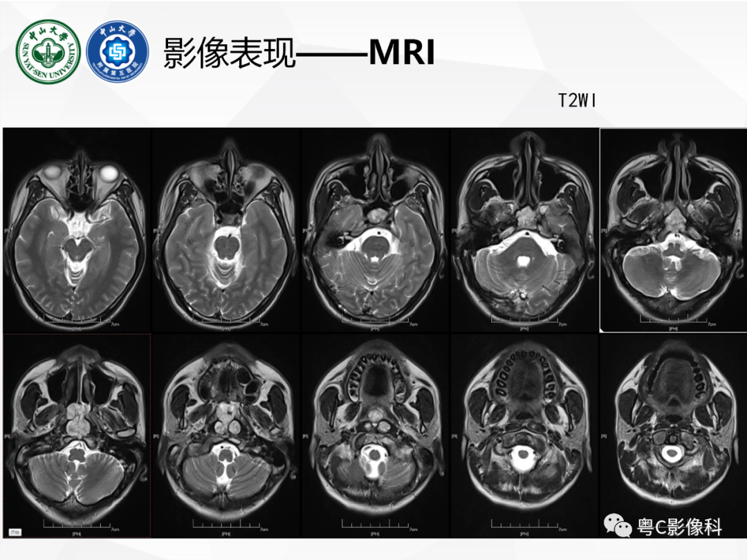 影像PPT - 【病例】颅底脊索瘤1例CT及MR影像表现及鉴别诊断-10