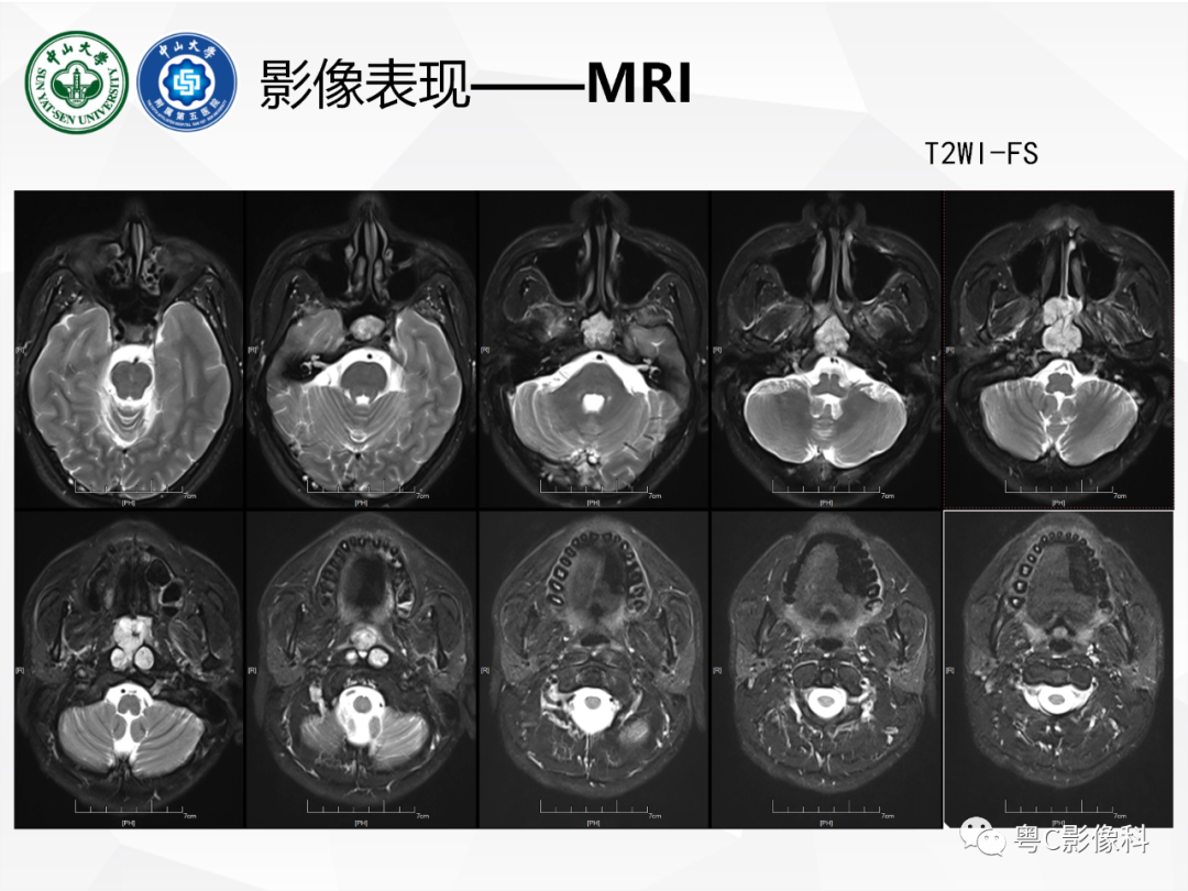 影像PPT - 【病例】颅底脊索瘤1例CT及MR影像表现及鉴别诊断-11