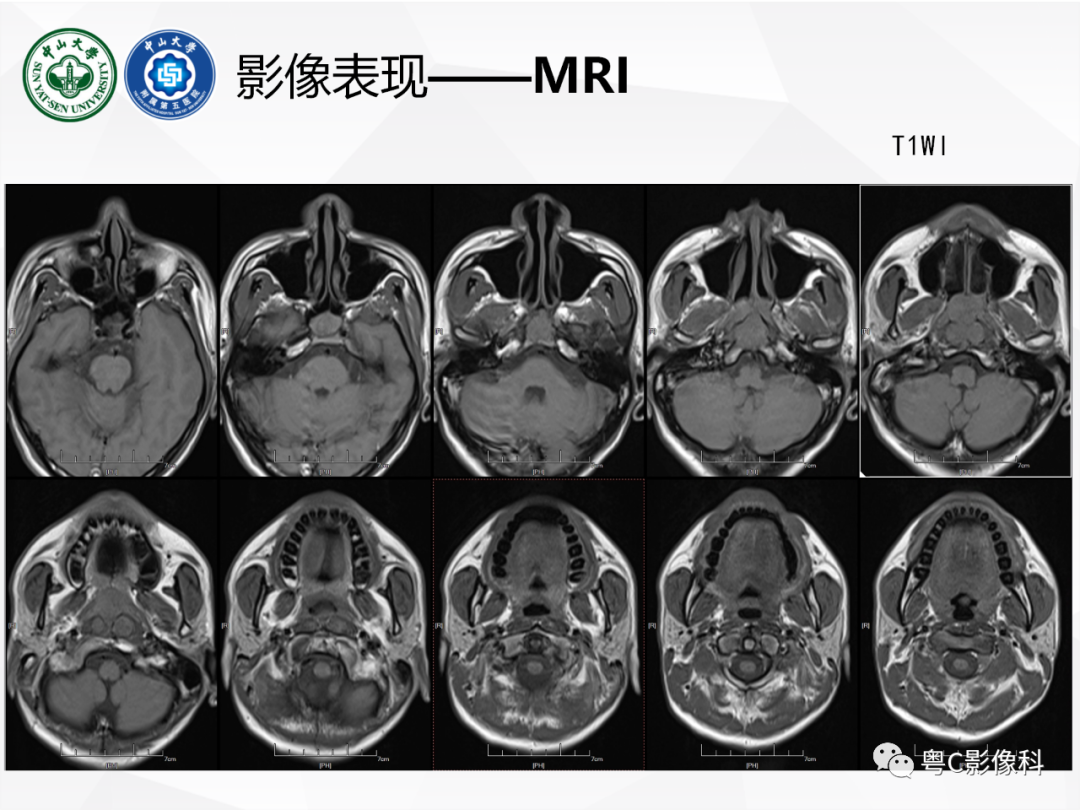 影像PPT - 【病例】颅底脊索瘤1例CT及MR影像表现及鉴别诊断-12