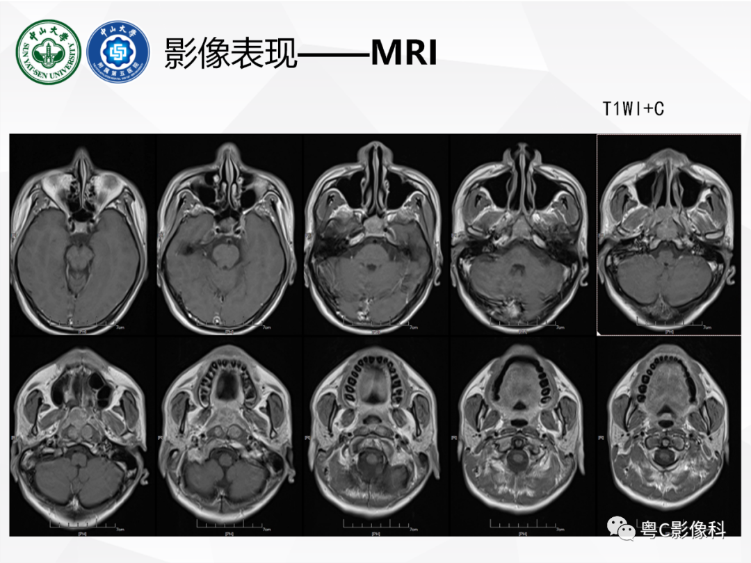 影像PPT - 【病例】颅底脊索瘤1例CT及MR影像表现及鉴别诊断-13