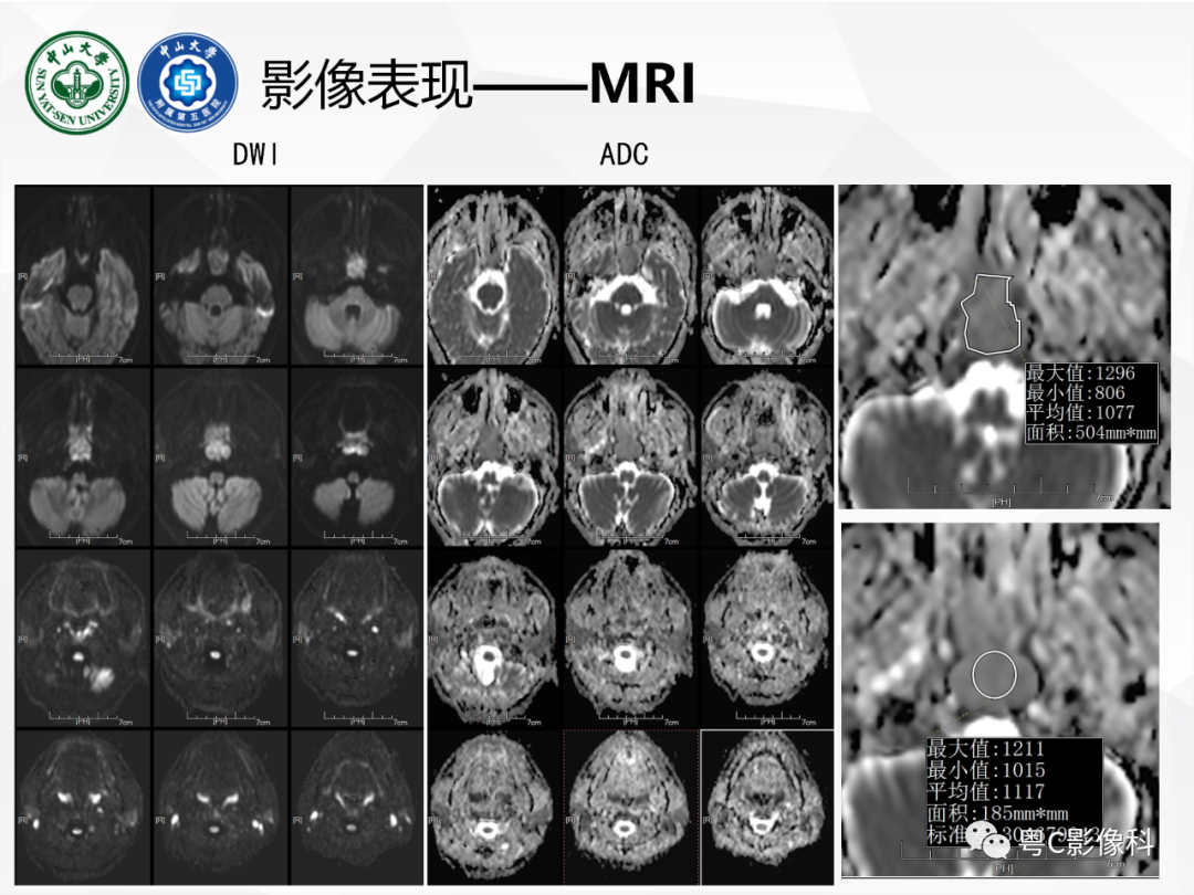 影像PPT - 【病例】颅底脊索瘤1例CT及MR影像表现及鉴别诊断-14