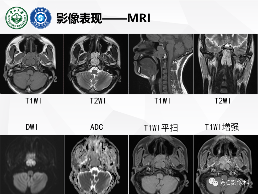 影像PPT - 【病例】颅底脊索瘤1例CT及MR影像表现及鉴别诊断-15