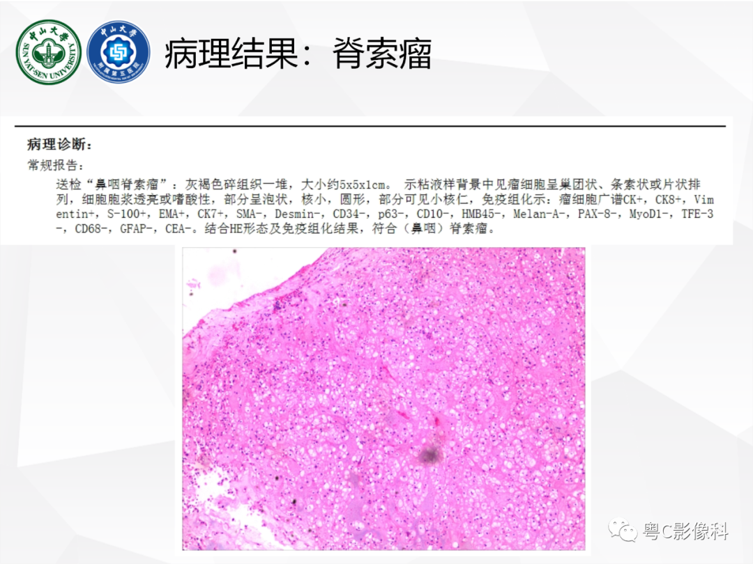 影像PPT - 【病例】颅底脊索瘤1例CT及MR影像表现及鉴别诊断-19