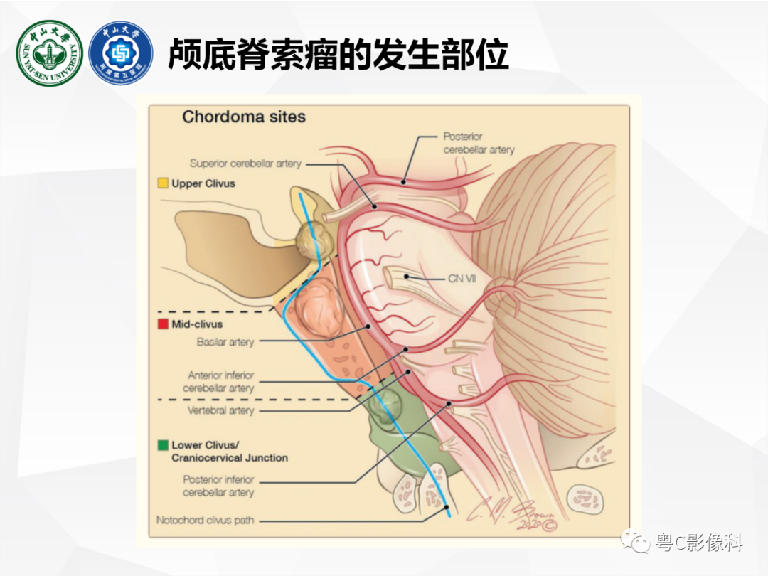 影像PPT - 【病例】颅底脊索瘤1例CT及MR影像表现及鉴别诊断-21
