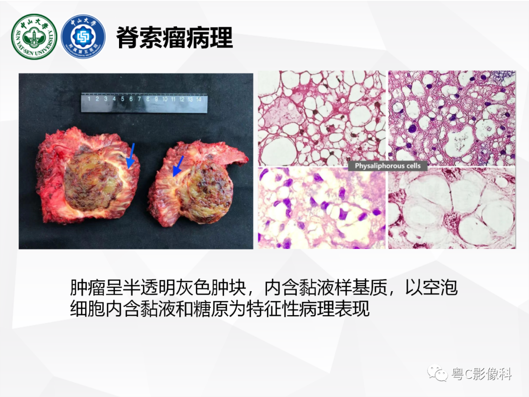 影像PPT - 【病例】颅底脊索瘤1例CT及MR影像表现及鉴别诊断-23