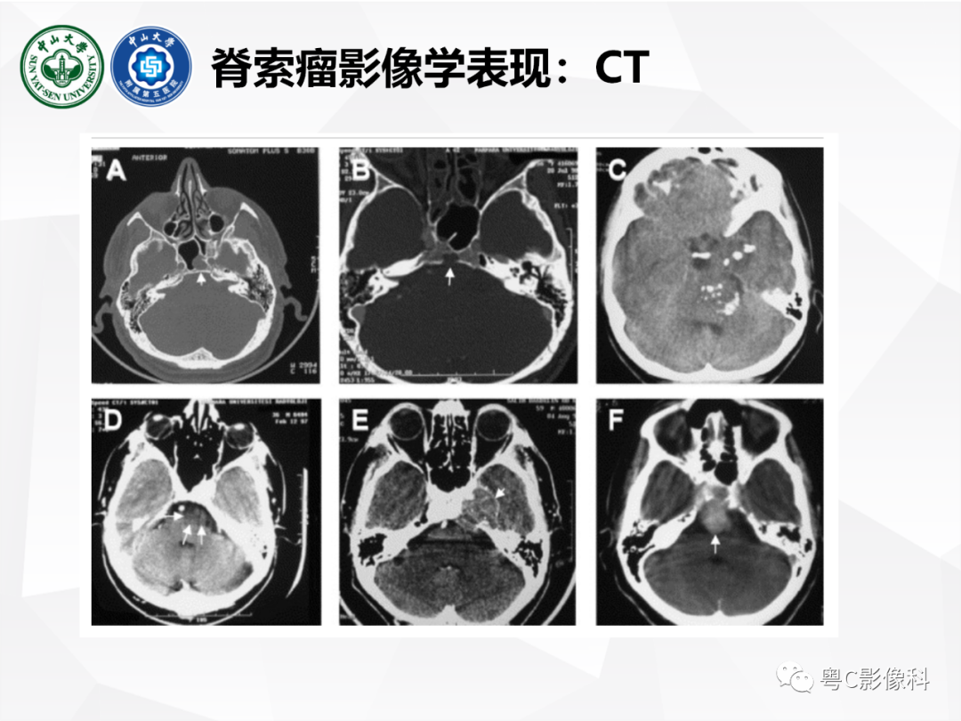 影像PPT - 【病例】颅底脊索瘤1例CT及MR影像表现及鉴别诊断-26