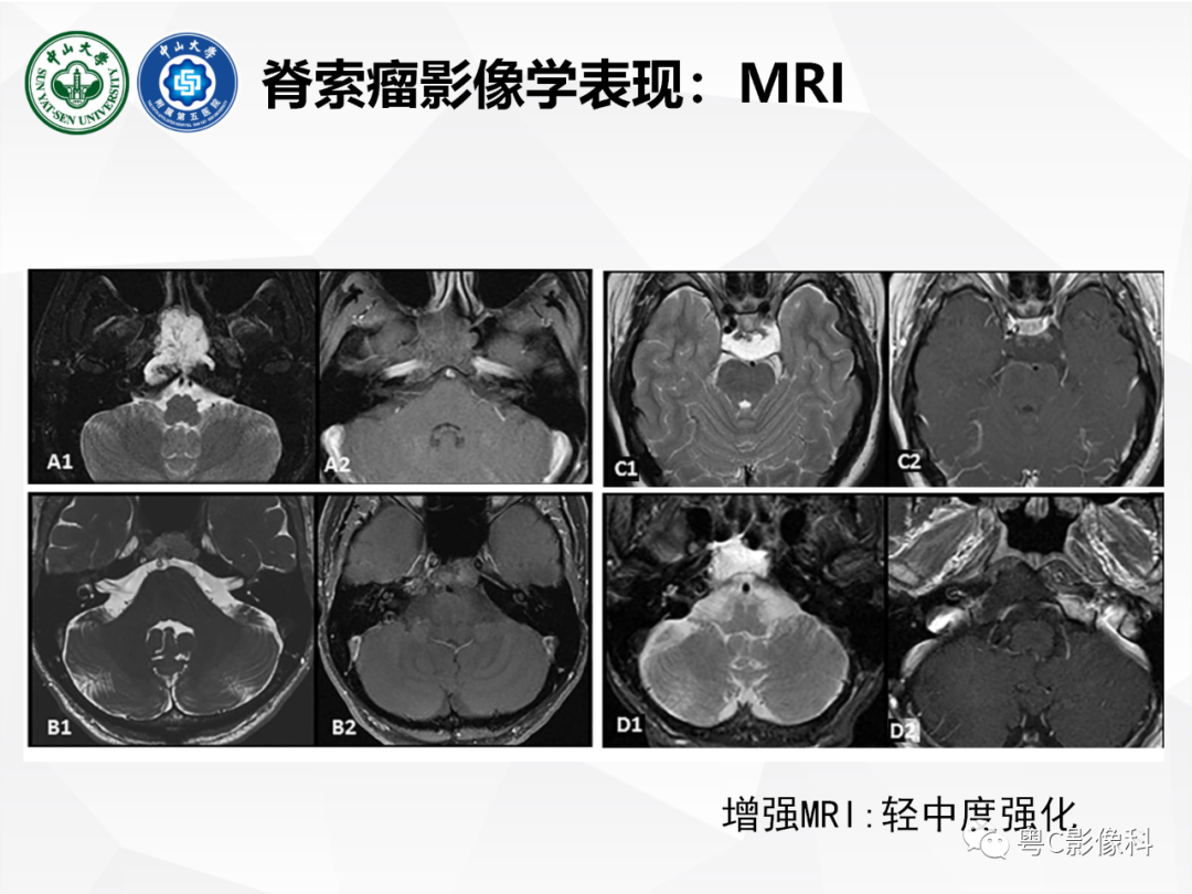 影像PPT - 【病例】颅底脊索瘤1例CT及MR影像表现及鉴别诊断-28