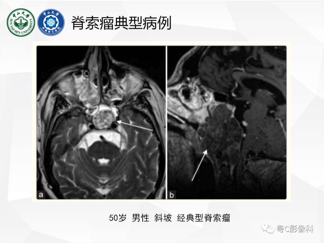 影像PPT - 【病例】颅底脊索瘤1例CT及MR影像表现及鉴别诊断-30