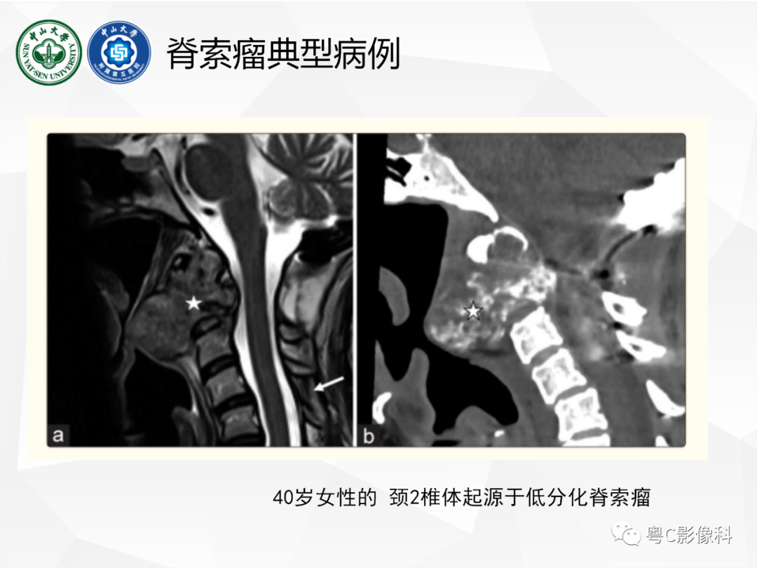 影像PPT - 【病例】颅底脊索瘤1例CT及MR影像表现及鉴别诊断-31