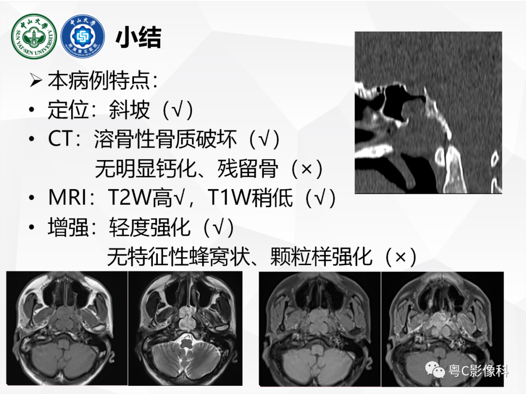 影像PPT - 【病例】颅底脊索瘤1例CT及MR影像表现及鉴别诊断-33