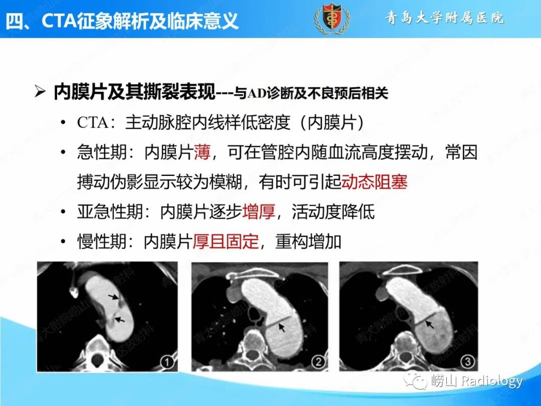 影像PPT - 【PPT】主动脉夹层的CT征象及临床意义再认识-9