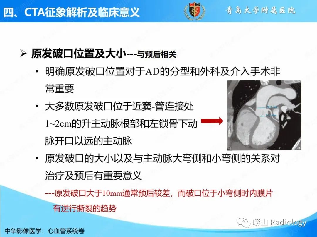 影像PPT - 【PPT】主动脉夹层的CT征象及临床意义再认识-11