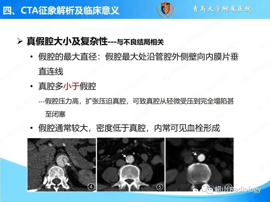 影像PPT - 【PPT】主动脉夹层的CT征象及临床意义再认识-12
