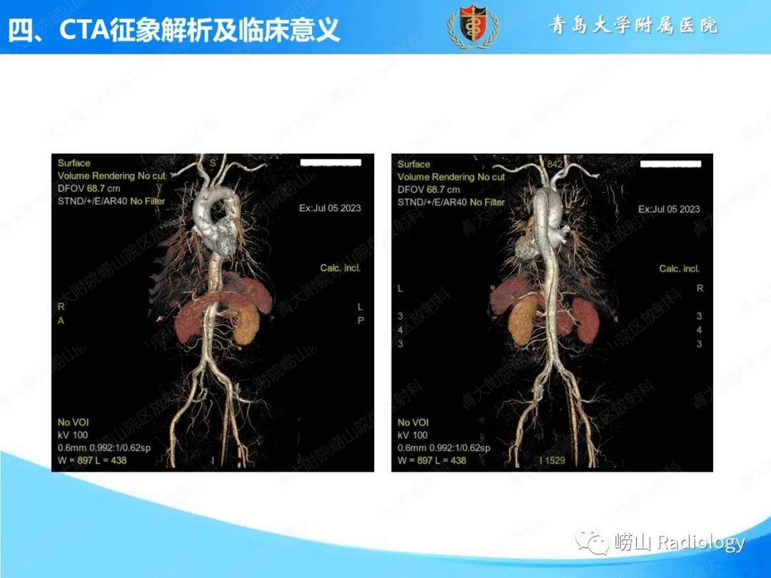 影像PPT - 【PPT】主动脉夹层的CT征象及临床意义再认识-16