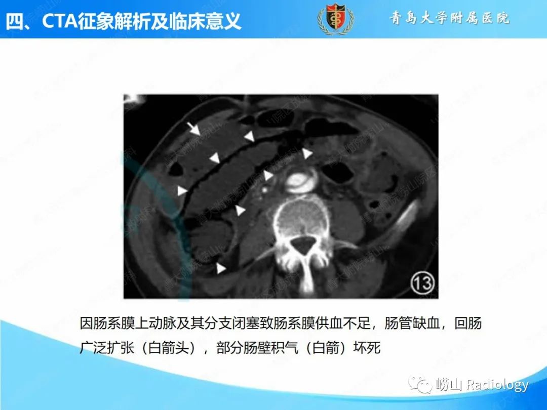 影像PPT - 【PPT】主动脉夹层的CT征象及临床意义再认识-22