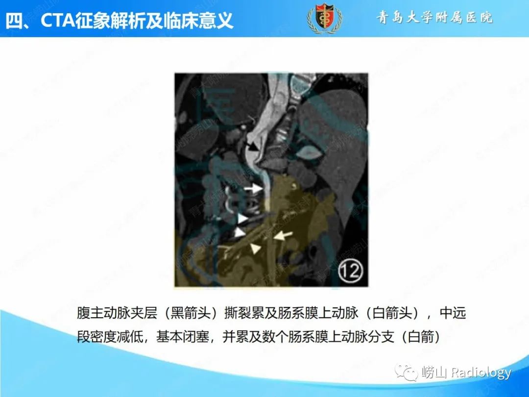 影像PPT - 【PPT】主动脉夹层的CT征象及临床意义再认识-21