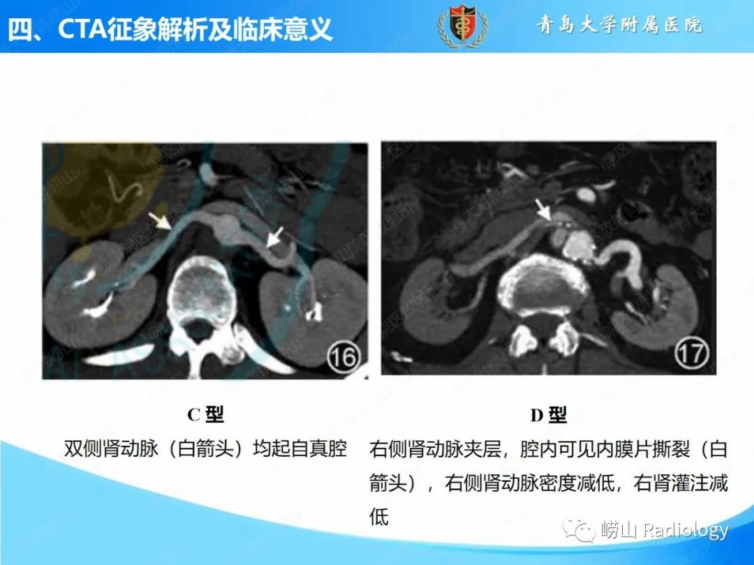 影像PPT - 【PPT】主动脉夹层的CT征象及临床意义再认识-25
