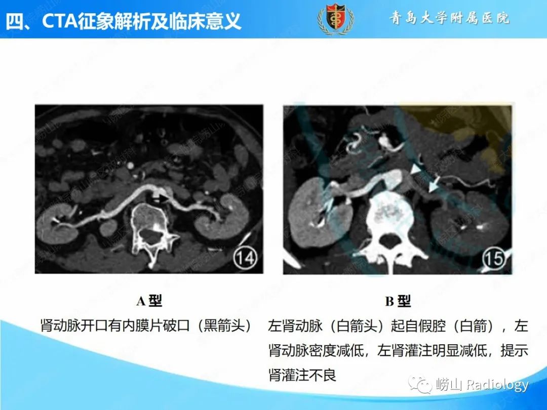 影像PPT - 【PPT】主动脉夹层的CT征象及临床意义再认识-24