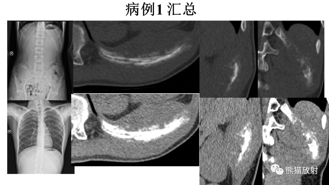 影像PPT - 【病例】肋骨尤文肉瘤 & 股骨骨髓炎-4