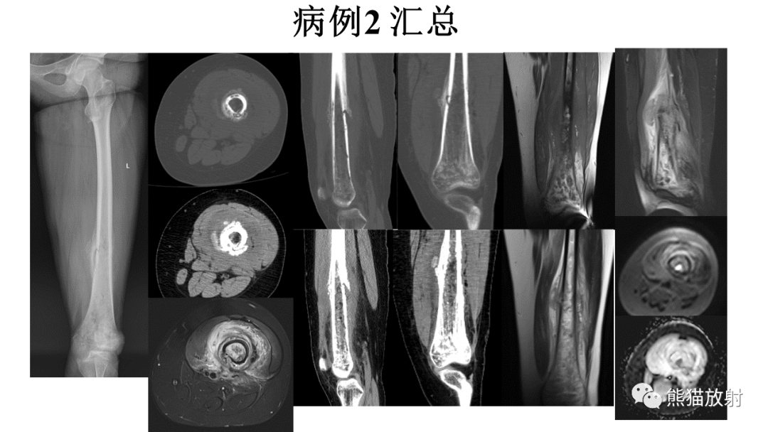 影像PPT - 【病例】肋骨尤文肉瘤 & 股骨骨髓炎-9
