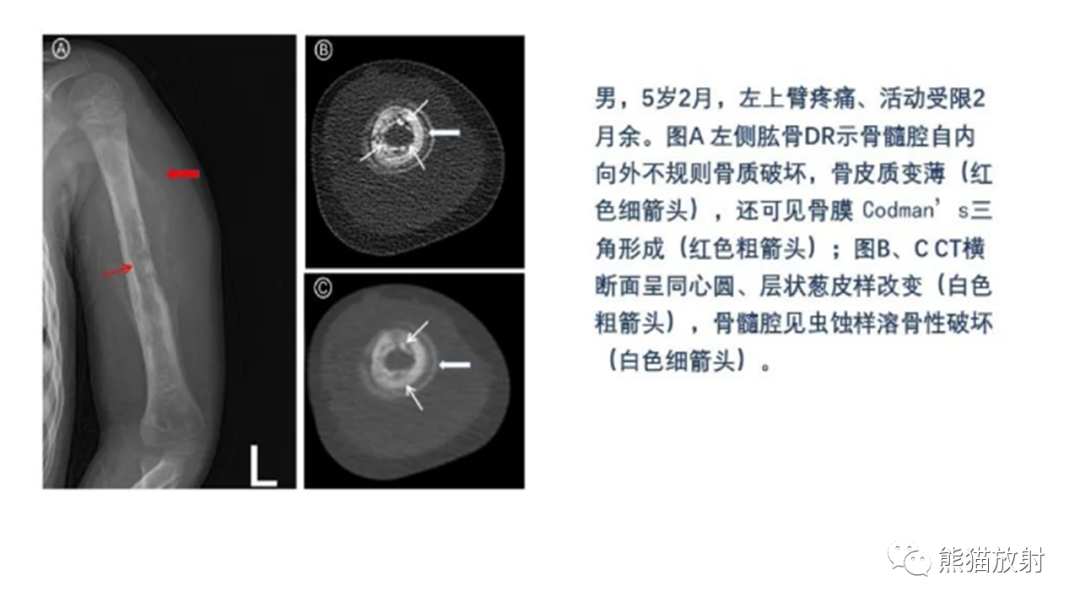 影像PPT - 【病例】肋骨尤文肉瘤 & 股骨骨髓炎-21