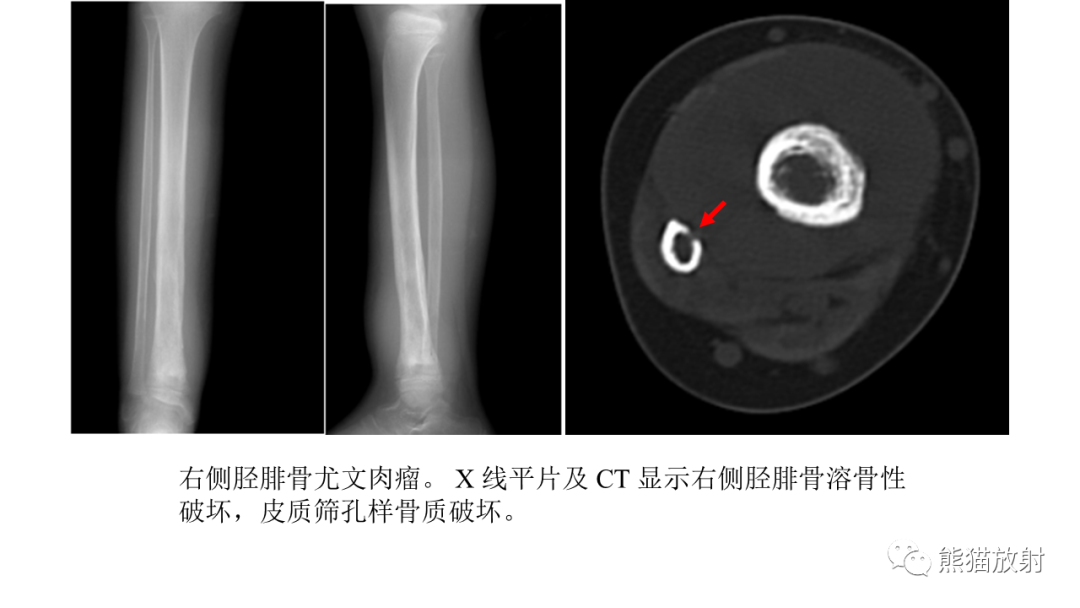 影像PPT - 【病例】肋骨尤文肉瘤 & 股骨骨髓炎-22