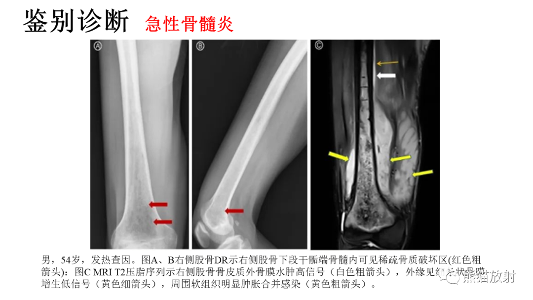 影像PPT - 【病例】肋骨尤文肉瘤 & 股骨骨髓炎-27
