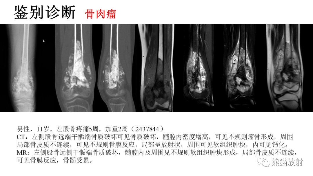 影像PPT - 【病例】肋骨尤文肉瘤 & 股骨骨髓炎-32