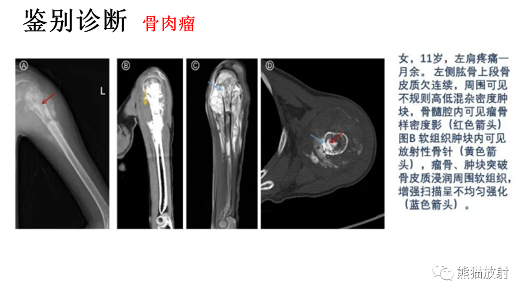 影像PPT - 【病例】肋骨尤文肉瘤 & 股骨骨髓炎-33