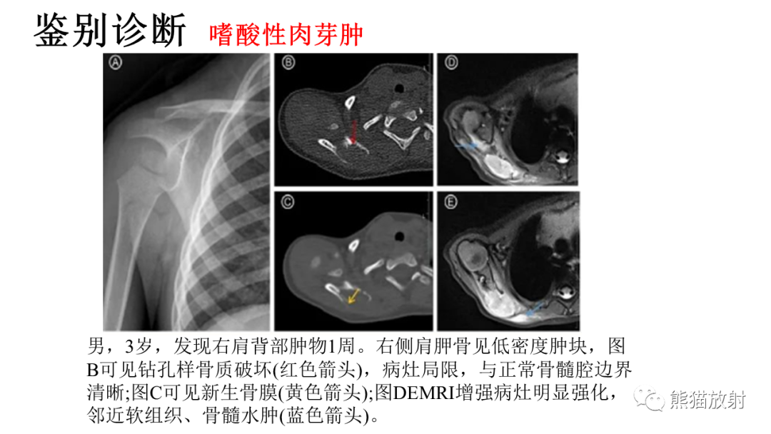影像PPT - 【病例】肋骨尤文肉瘤 & 股骨骨髓炎-37