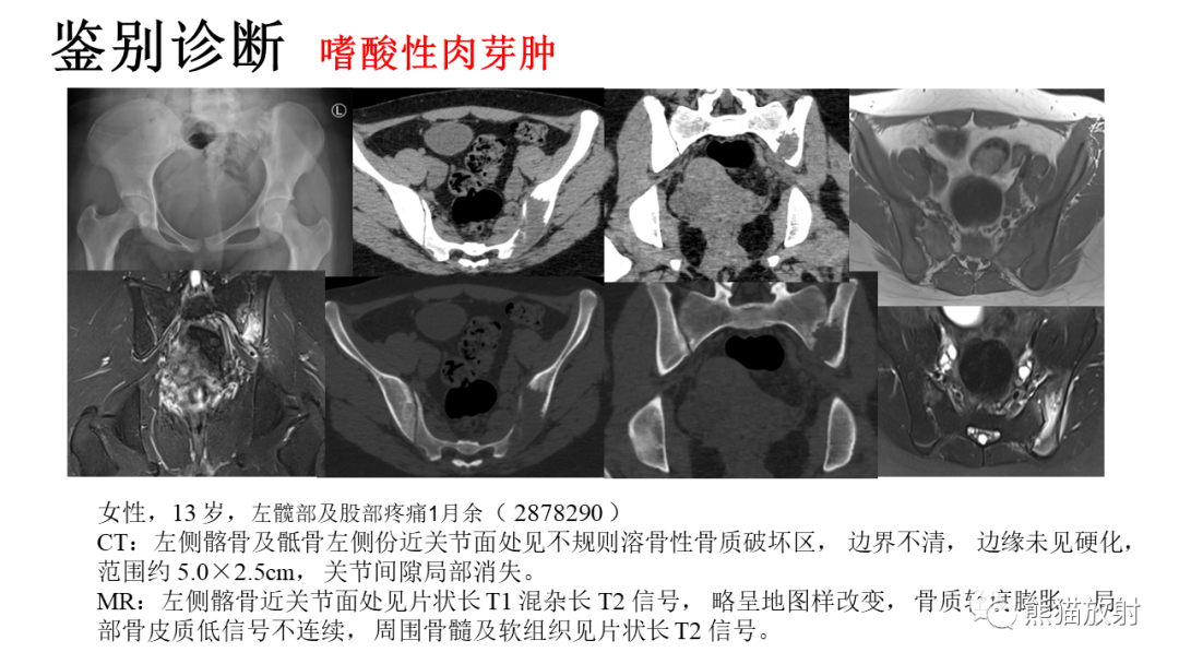 影像PPT - 【病例】肋骨尤文肉瘤 & 股骨骨髓炎-38