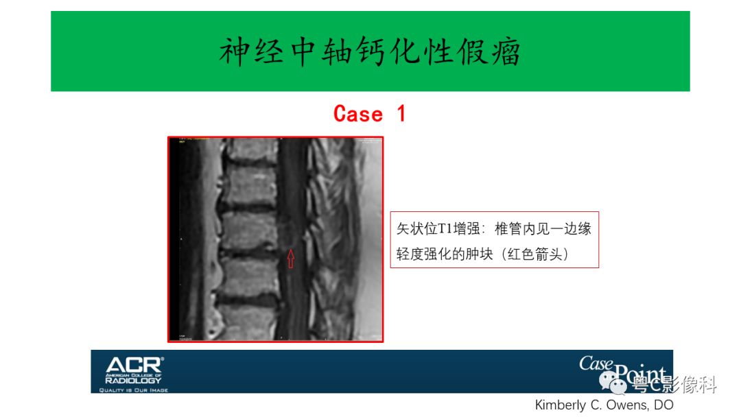 影像PPT - 【PPT】神经中轴钙化性假瘤(CAPNON)的影像诊断及鉴别诊断-5