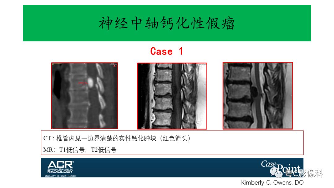 影像PPT - 【PPT】神经中轴钙化性假瘤(CAPNON)的影像诊断及鉴别诊断-4