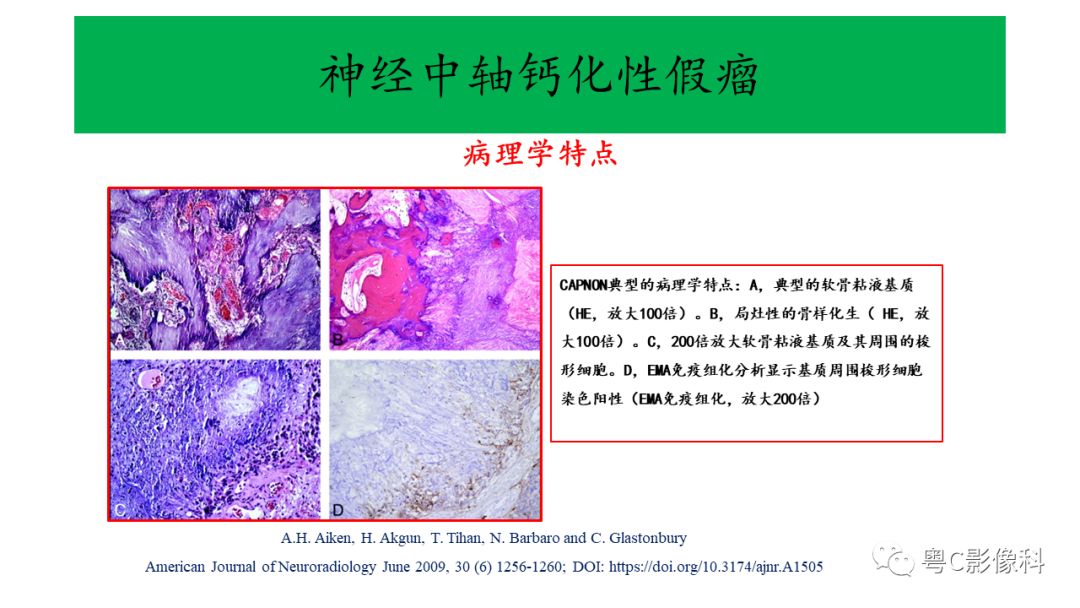 影像PPT - 【PPT】神经中轴钙化性假瘤(CAPNON)的影像诊断及鉴别诊断-8