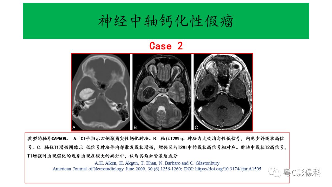 影像PPT - 【PPT】神经中轴钙化性假瘤(CAPNON)的影像诊断及鉴别诊断-9