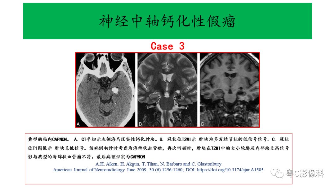 影像PPT - 【PPT】神经中轴钙化性假瘤(CAPNON)的影像诊断及鉴别诊断-10