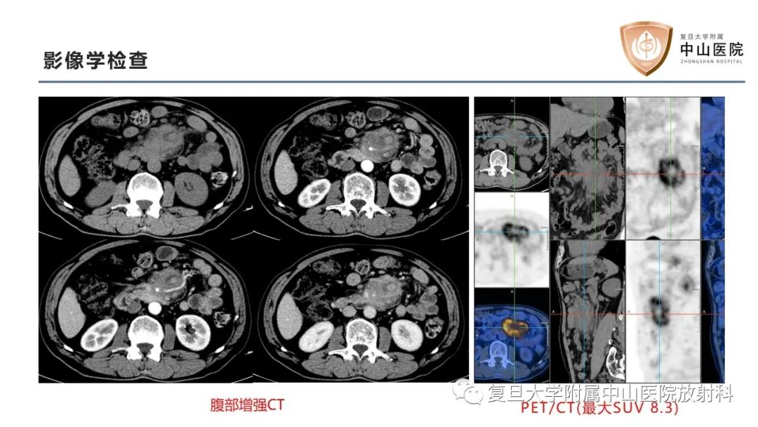 影像PPT - 【病例】肠系膜孤立性肿块3例CT影像鉴别-3