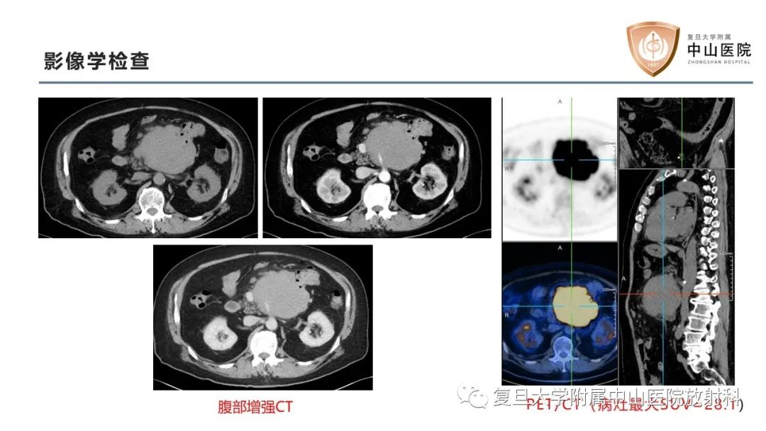 影像PPT - 【病例】肠系膜孤立性肿块3例CT影像鉴别-5