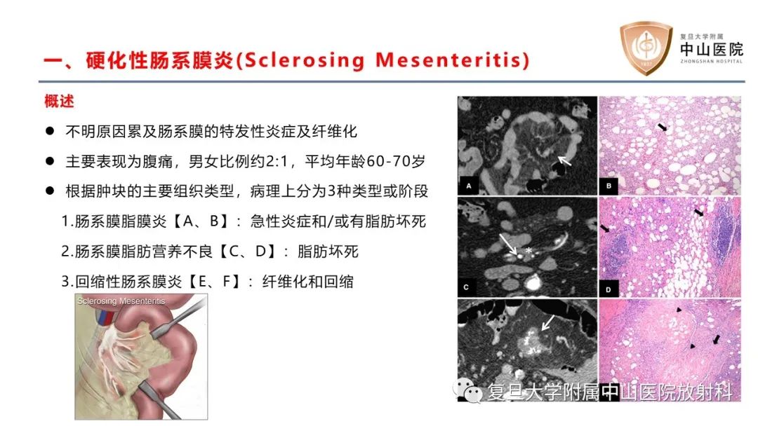 影像PPT - 【病例】肠系膜孤立性肿块3例CT影像鉴别-16