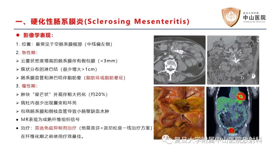 影像PPT - 【病例】肠系膜孤立性肿块3例CT影像鉴别-17
