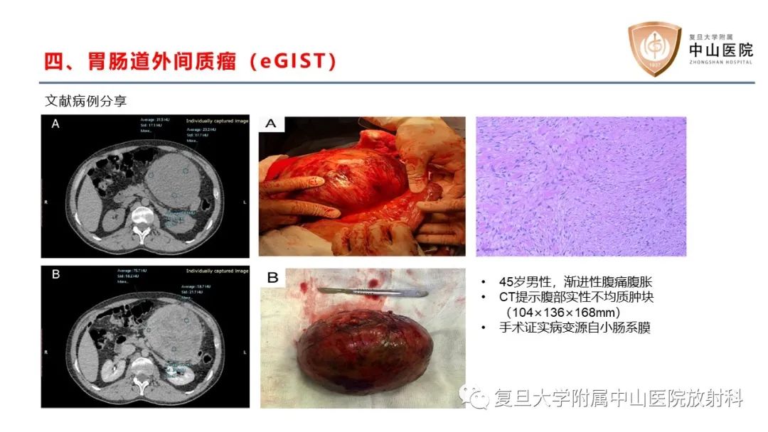 影像PPT - 【病例】肠系膜孤立性肿块3例CT影像鉴别-24
