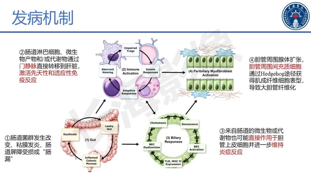 影像PPT - 【PPT】原发性硬化性胆管炎-28