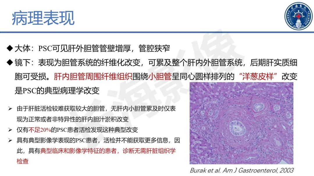 影像PPT - 【PPT】原发性硬化性胆管炎-30