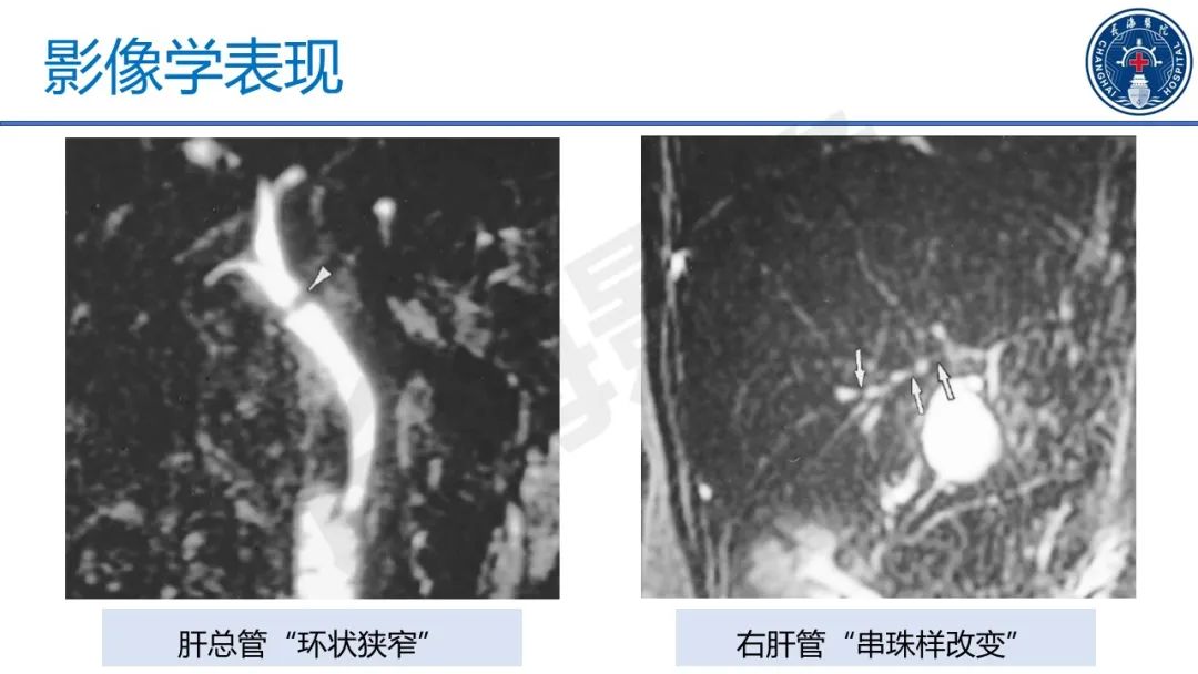影像PPT - 【PPT】原发性硬化性胆管炎-32