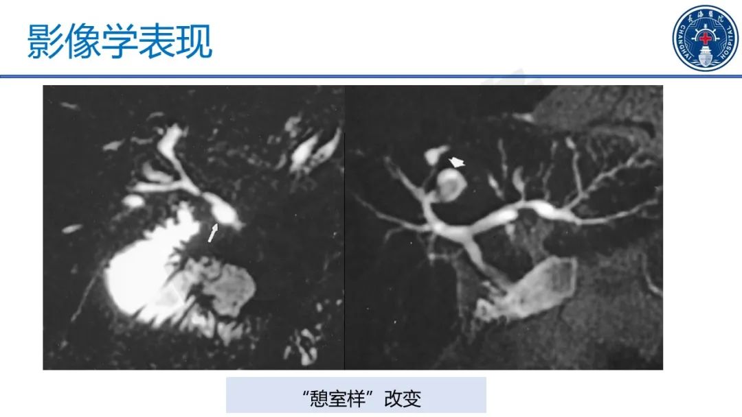 影像PPT - 【PPT】原发性硬化性胆管炎-33