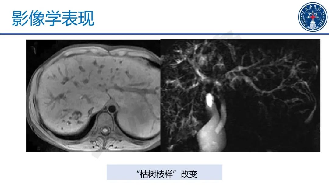 影像PPT - 【PPT】原发性硬化性胆管炎-34