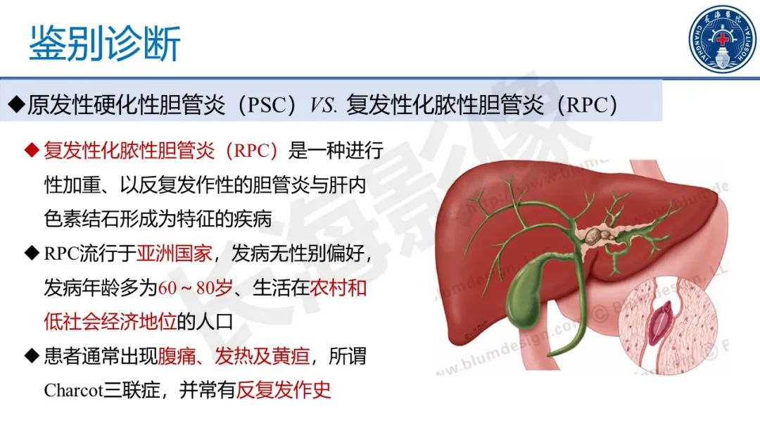 影像PPT - 【PPT】原发性硬化性胆管炎-42